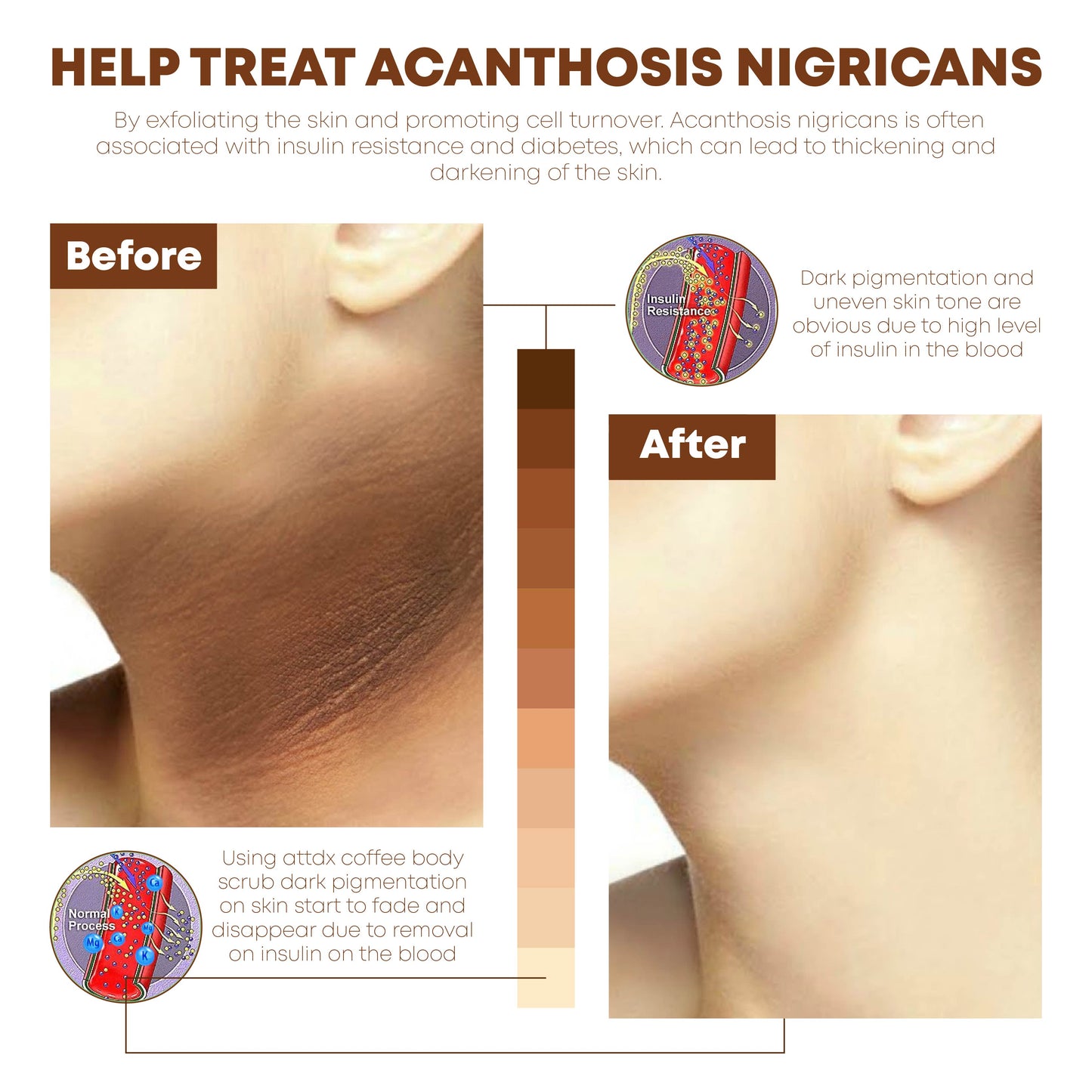 ATTDX Coffee Acanthosis Nigricans BodyScrub