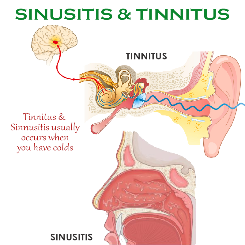 ATTDX Instant TinnitusReduce Relief Nasal Inhaler