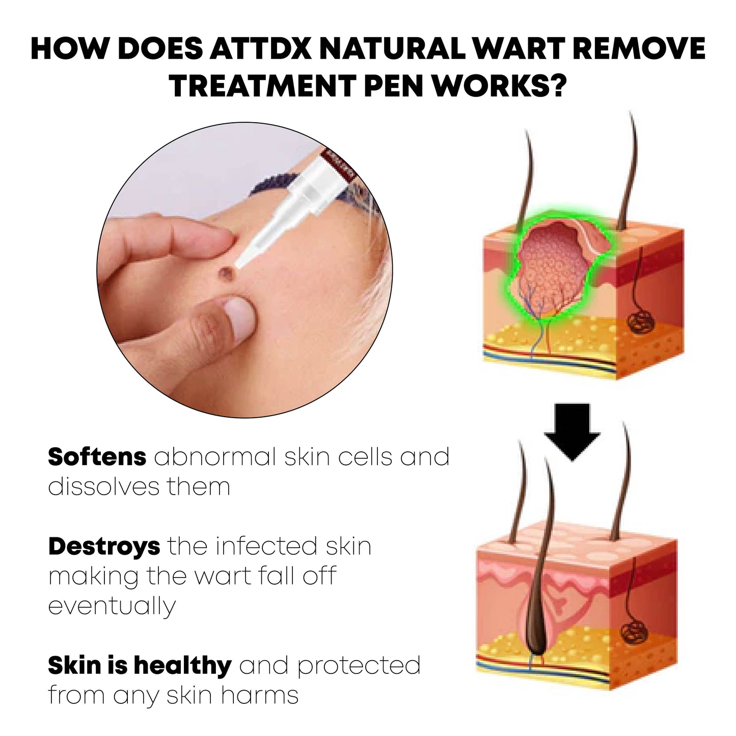 ATTDX Natural WartRemover Treatment Pen