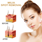 ATTDX Speedy Milia Removal Treatment