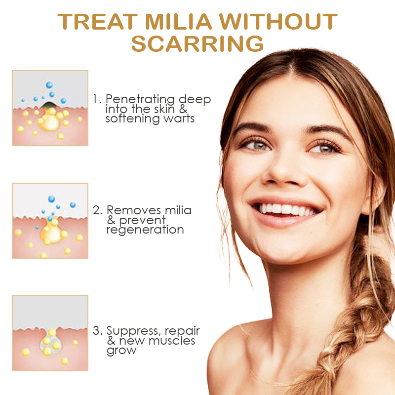 ATTDX Speedy Milia Removal Treatment