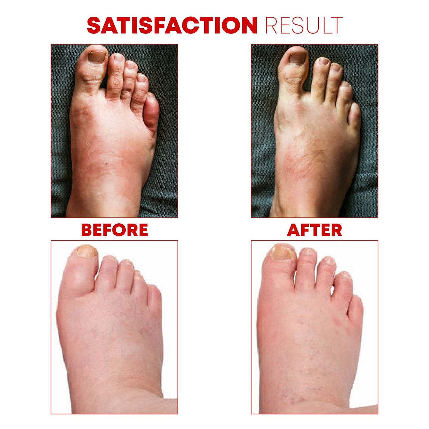 AntiSwelling GingerDetox FootPatch