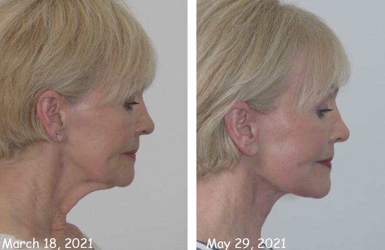 ATTDX SkinTightening Collagen NeckCream