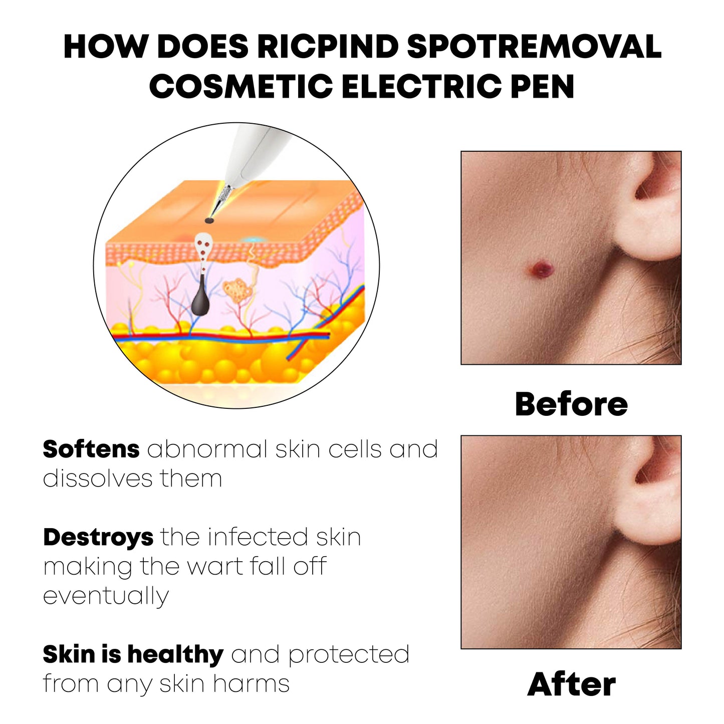 Ricpind SpotRemoval Cosmetic Electric Pen