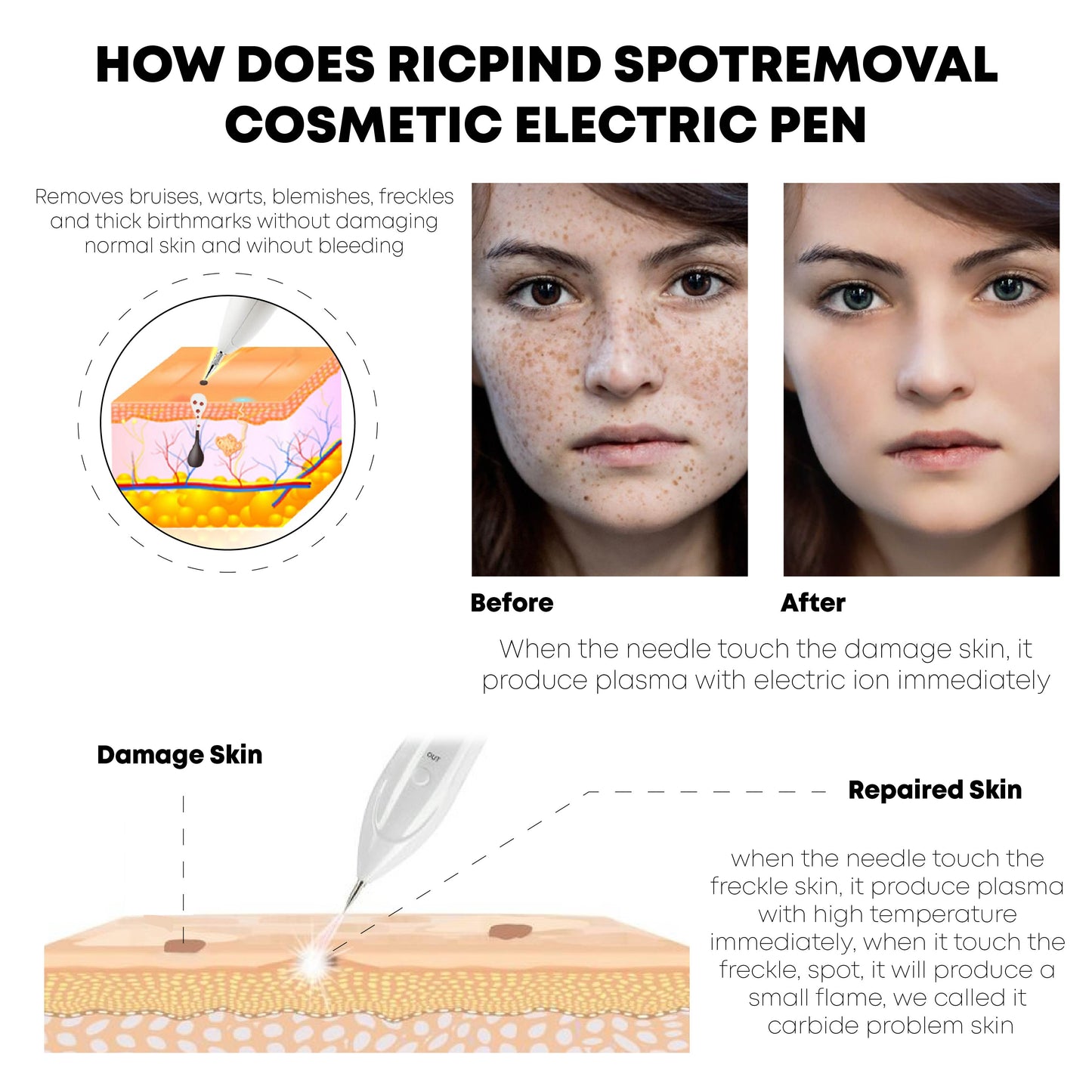 Ricpind SpotRemoval Cosmetic Electric Pen