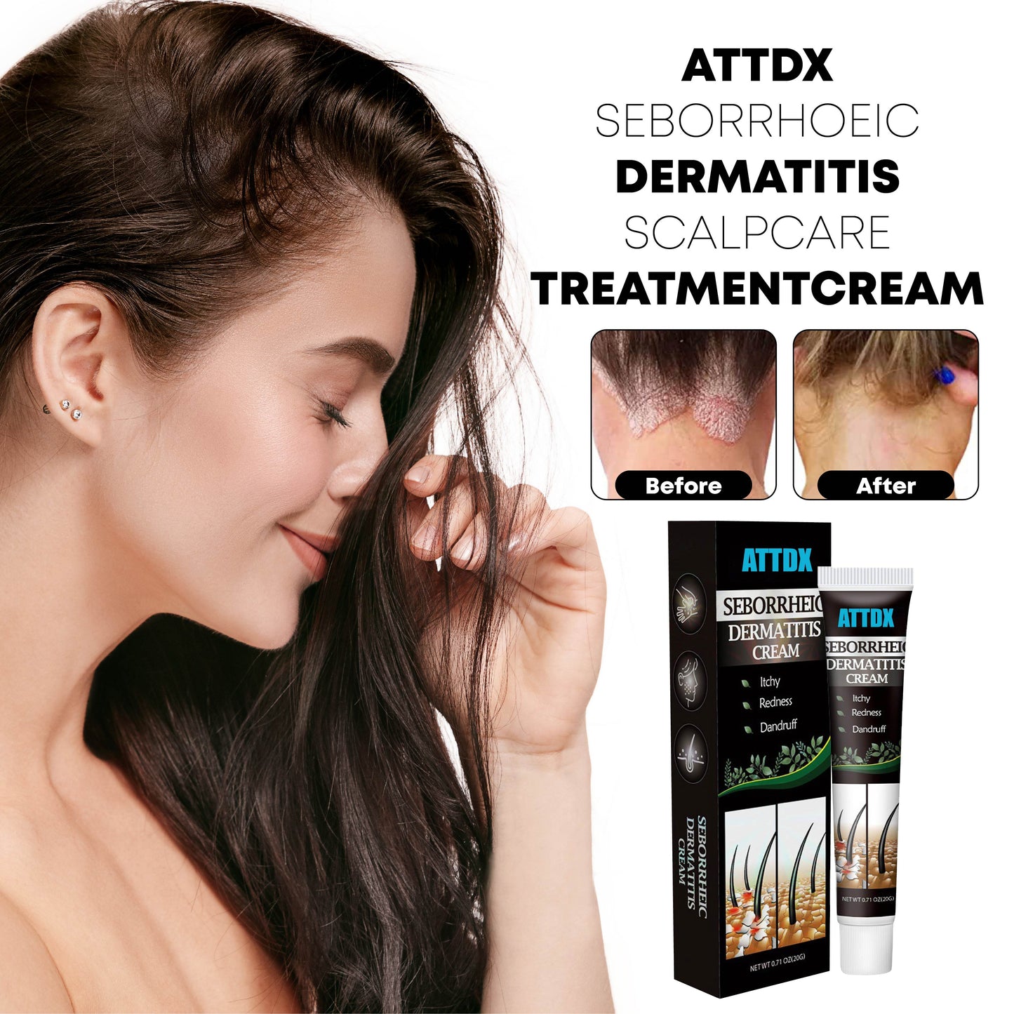 ATTDX SeborrhoeicDermatitis ScalpCare TreatmentCream